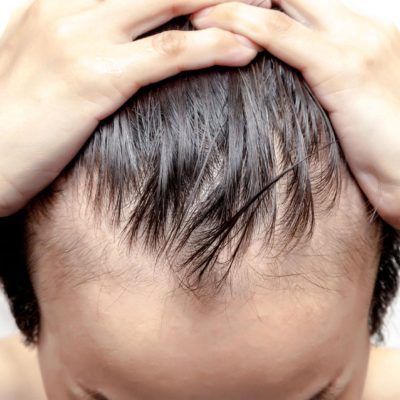 men hair loss cure