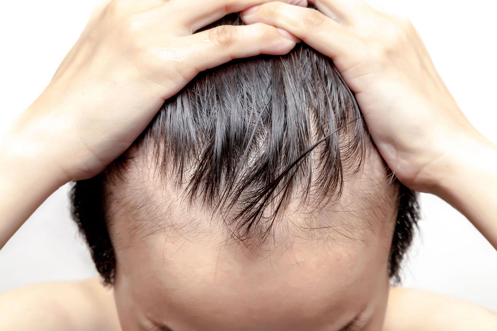 Is There a Cure for Male Pattern Baldness? | Regrowthclub Blog