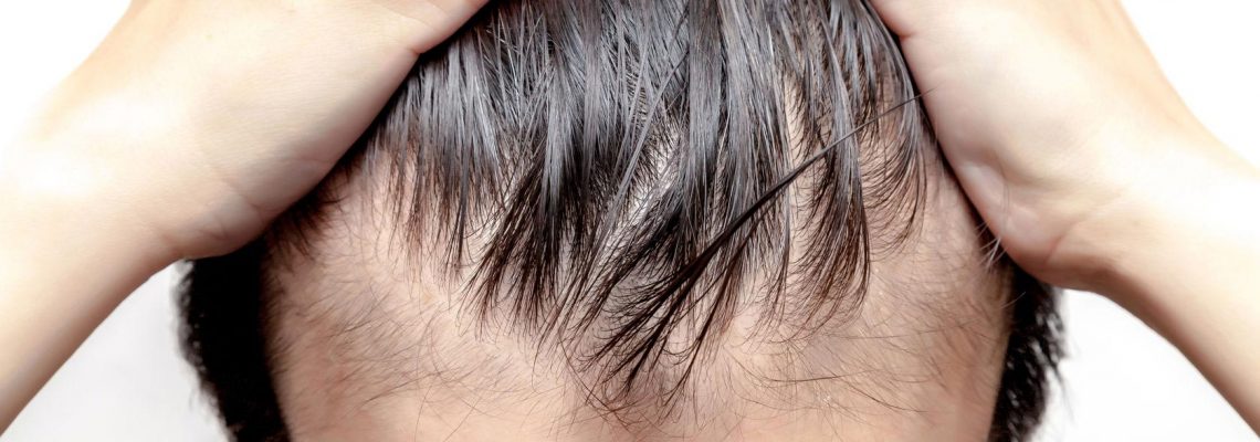 men hair loss cure